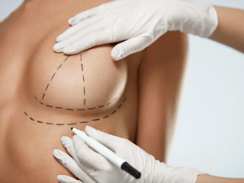 Breast Reduction Auckland, Female Plastic Surgeon