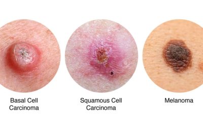 Comprehensive guide to skin cancer