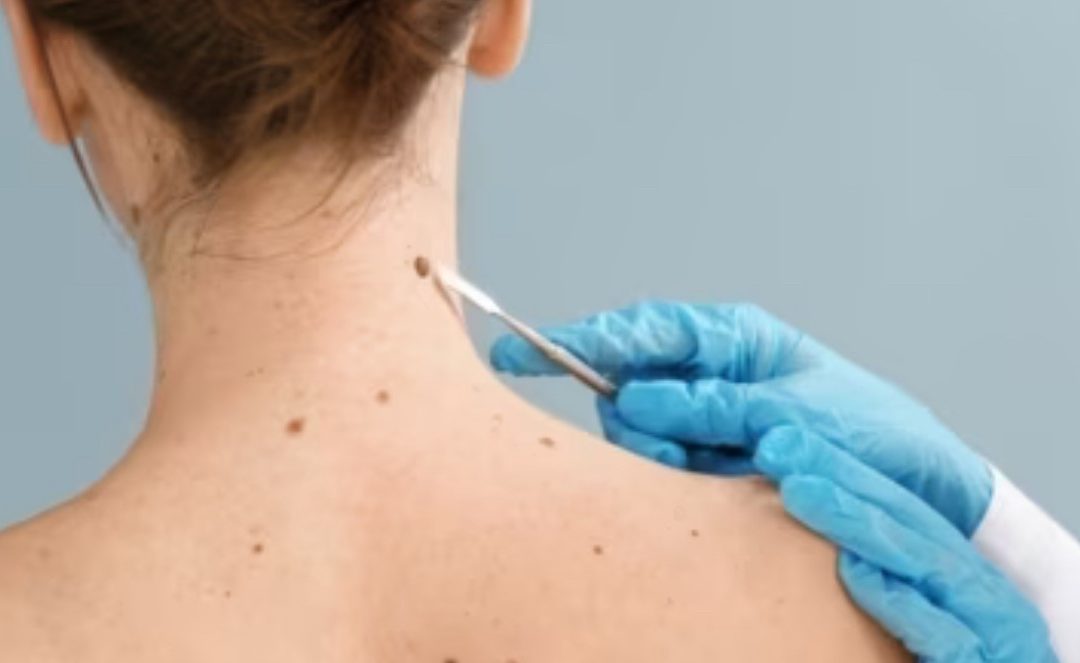 Skin Cancer treatment options – what you need to know