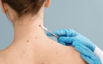 Skin Cancer treatment options – what you need to know