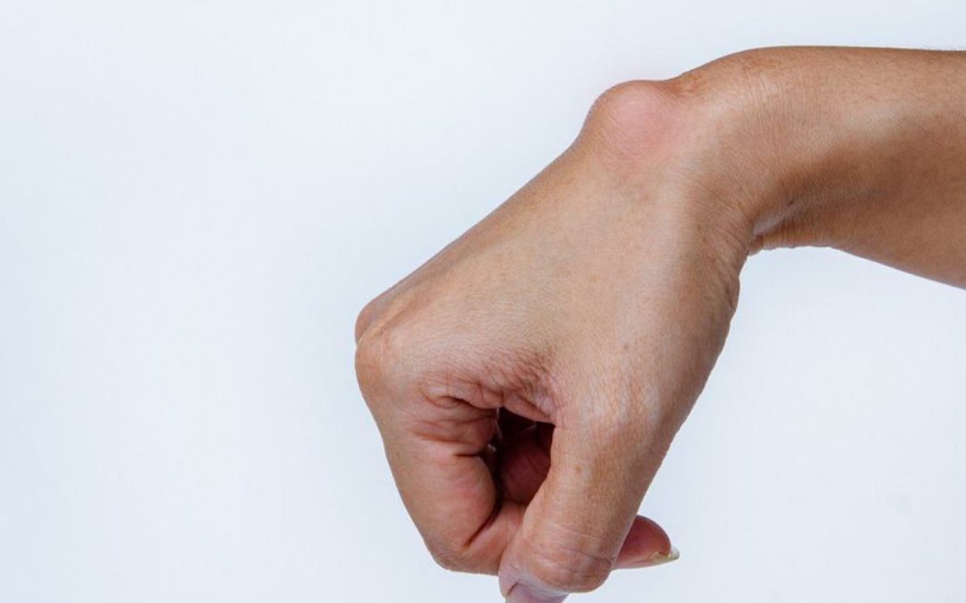 What is a wrist ganglion?